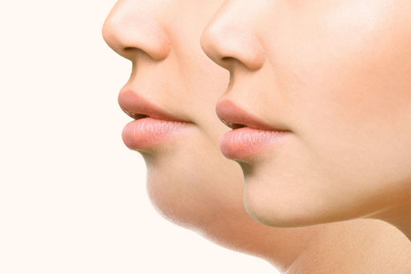 Избавление от второго подбородка Избавление от второго подбородка